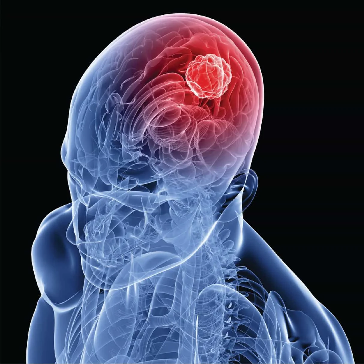 Treatments that can help you win the fight against brain tumours 